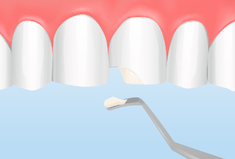 ダイレクトボンディング(即日での歯の審美治療)